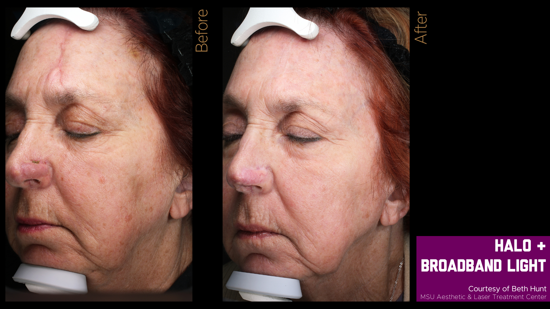 before and after photo of a halo treatment