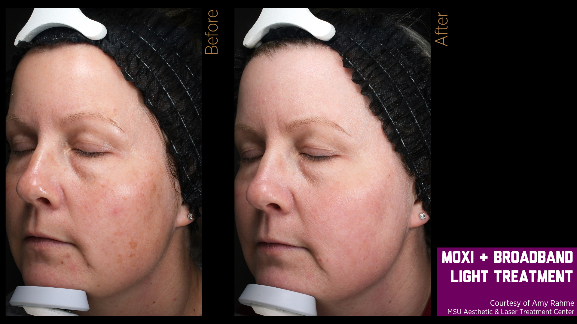 before and after treatment photos