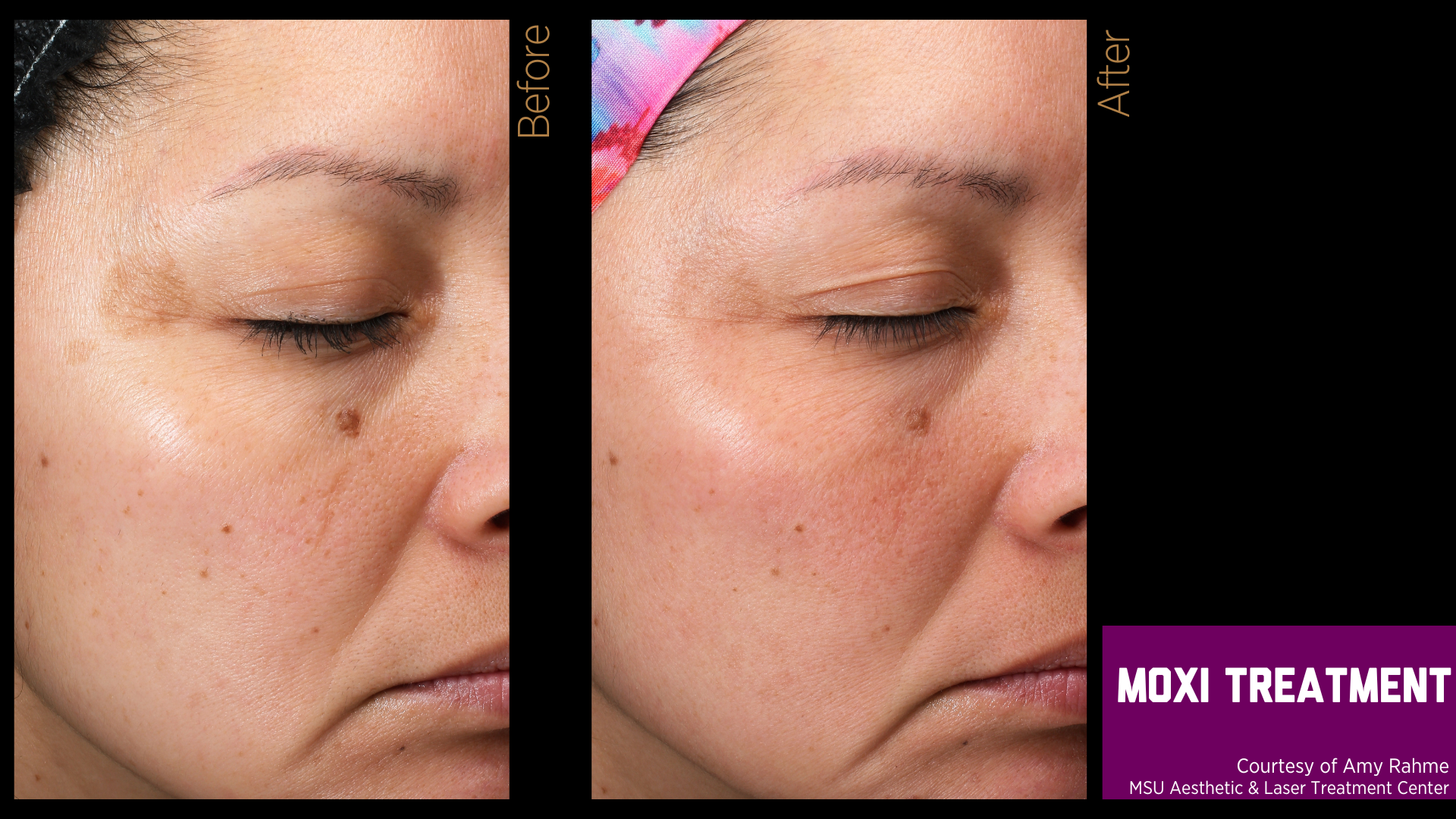 before and after treatment photos