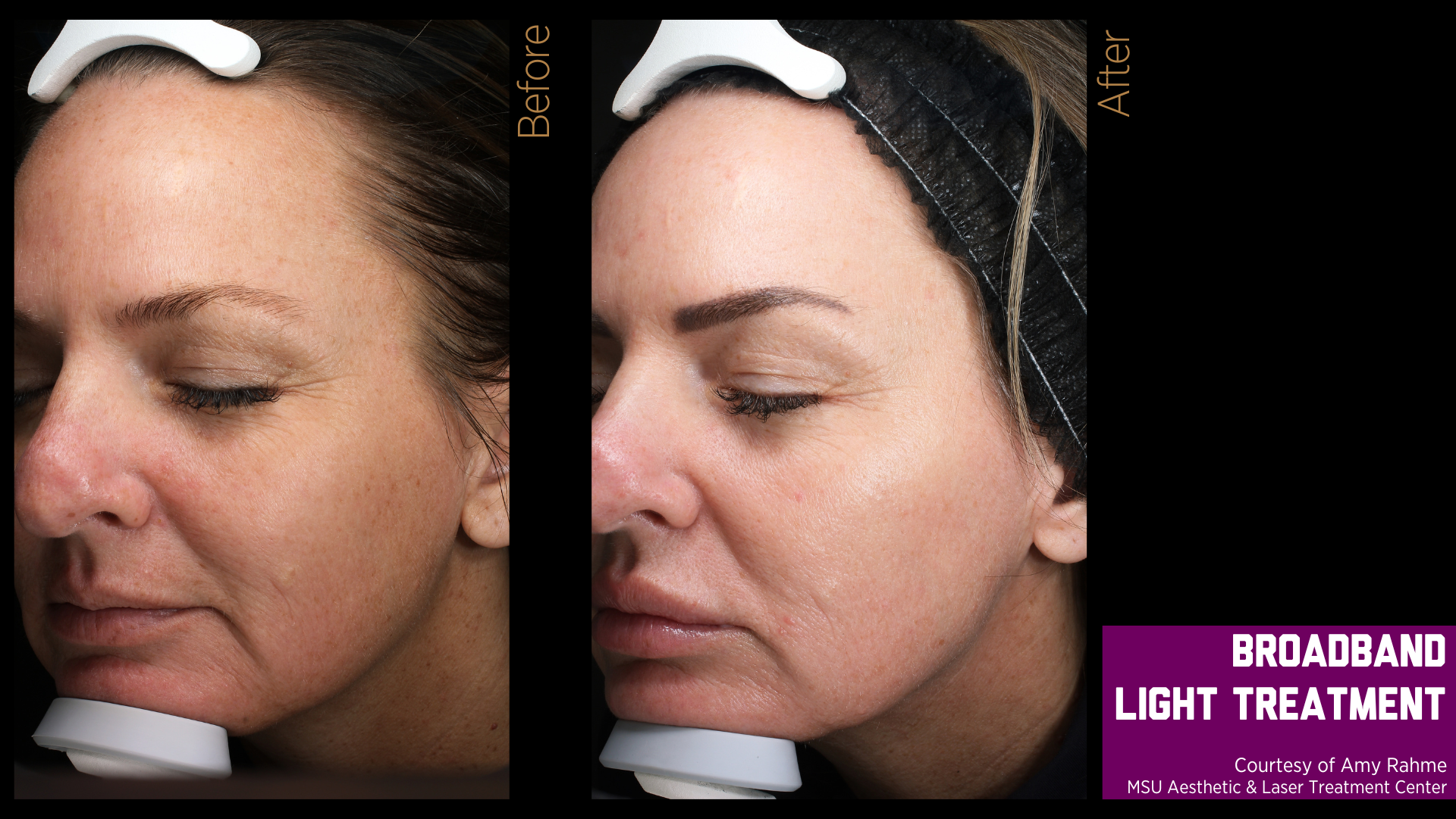 before and after treatment photos