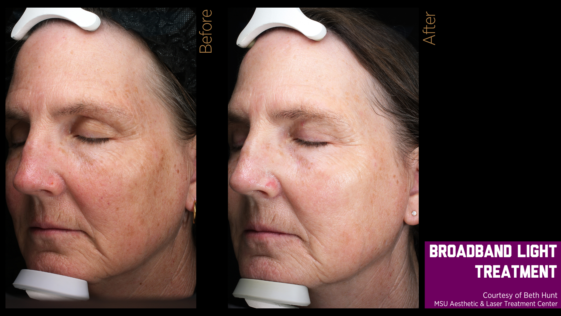 before and after treatment photos