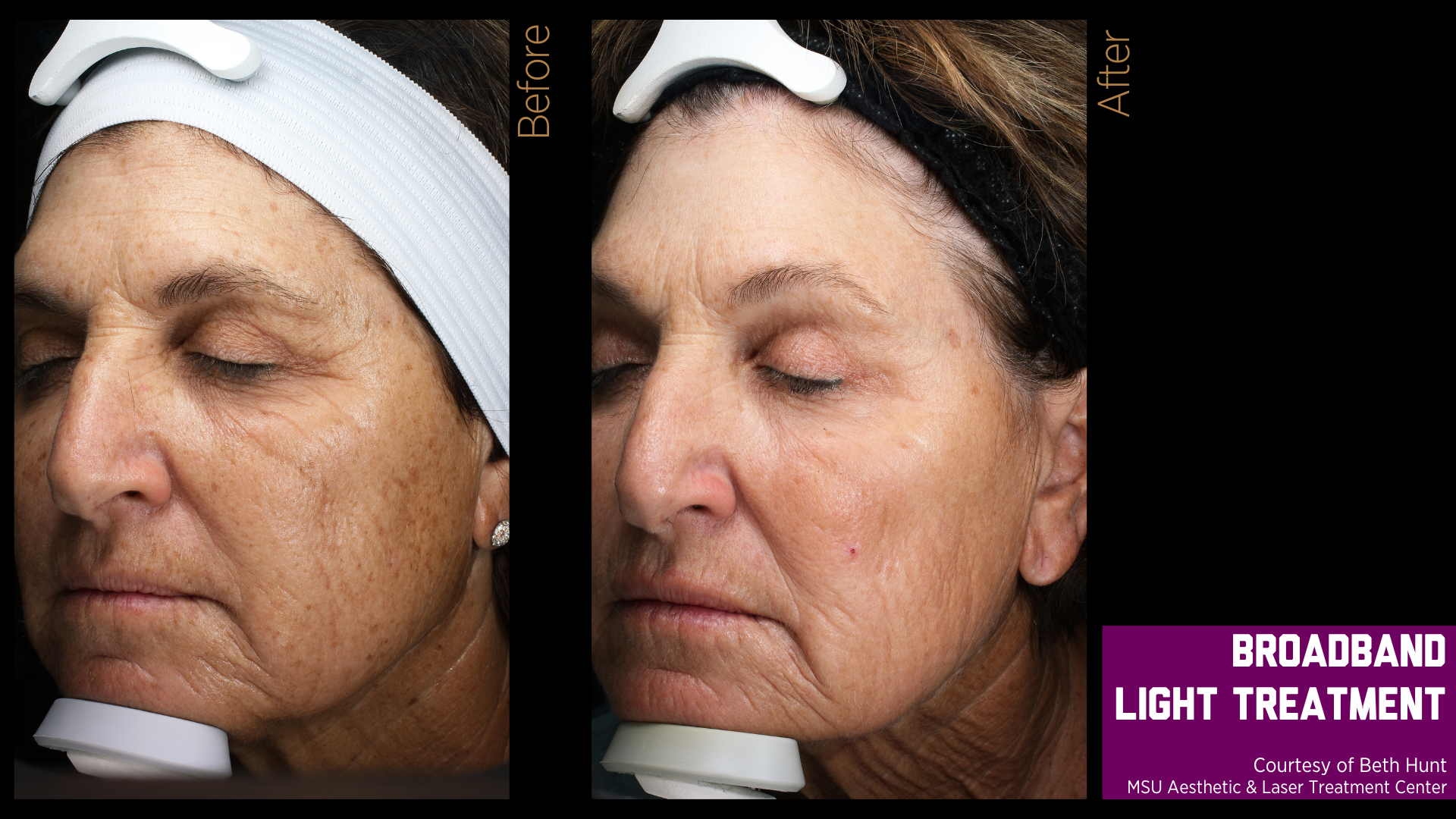 before and after treatment photos