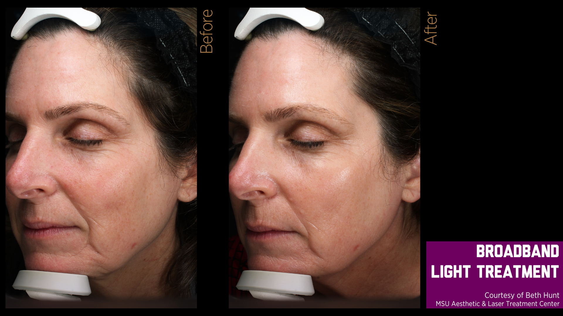 before and after treatment photos