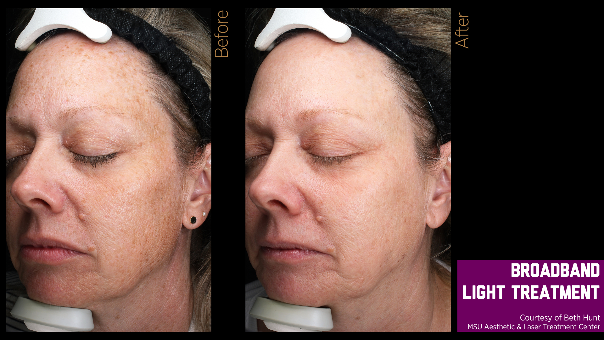 before and after treatment photos