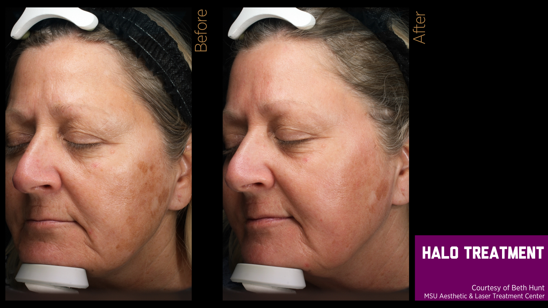 before and after treatment photos