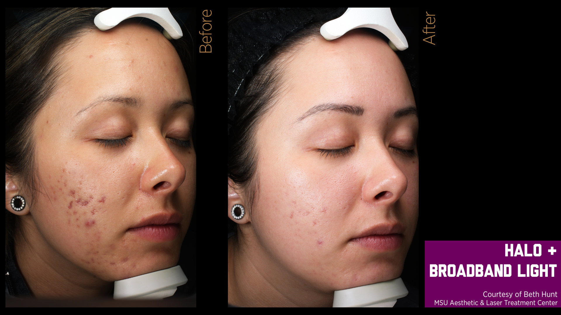 before and after treatment photos