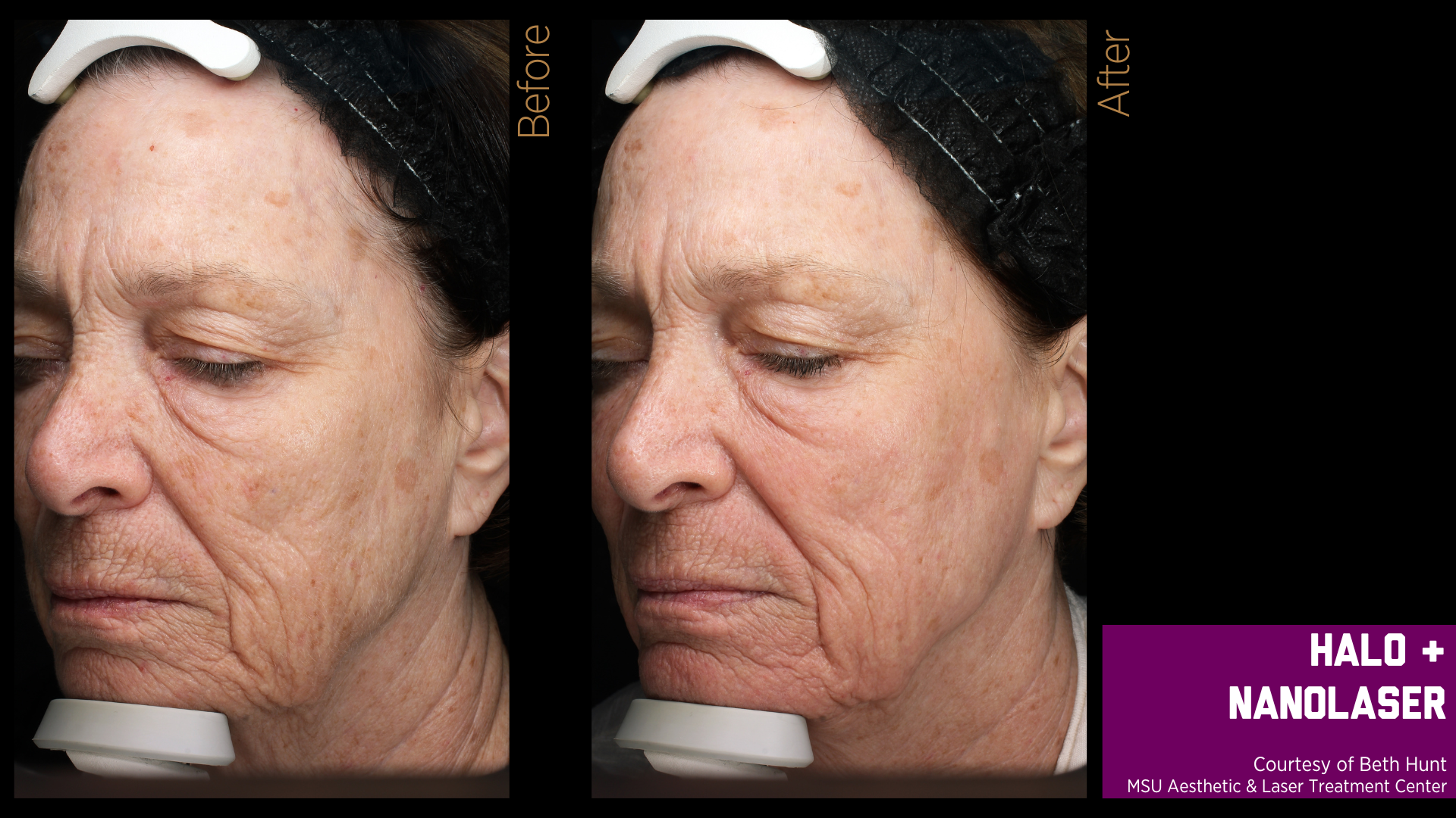 before and after treatment photos